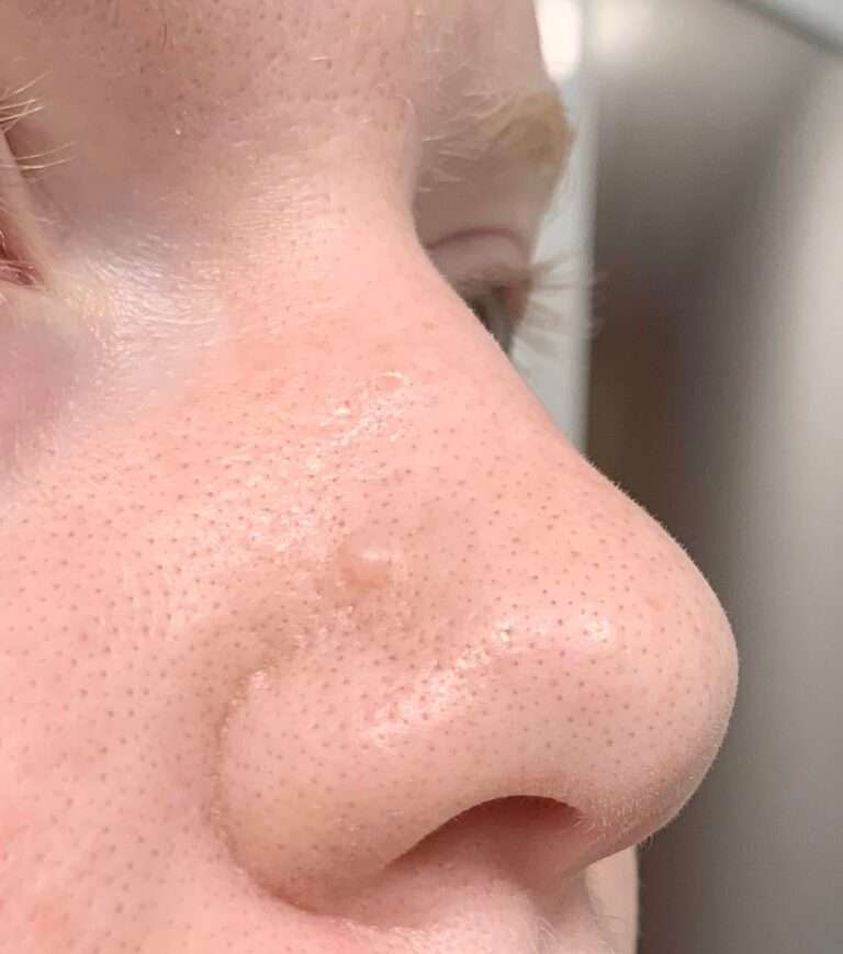 Fibrous Papule Of The Nose Vermontaco 