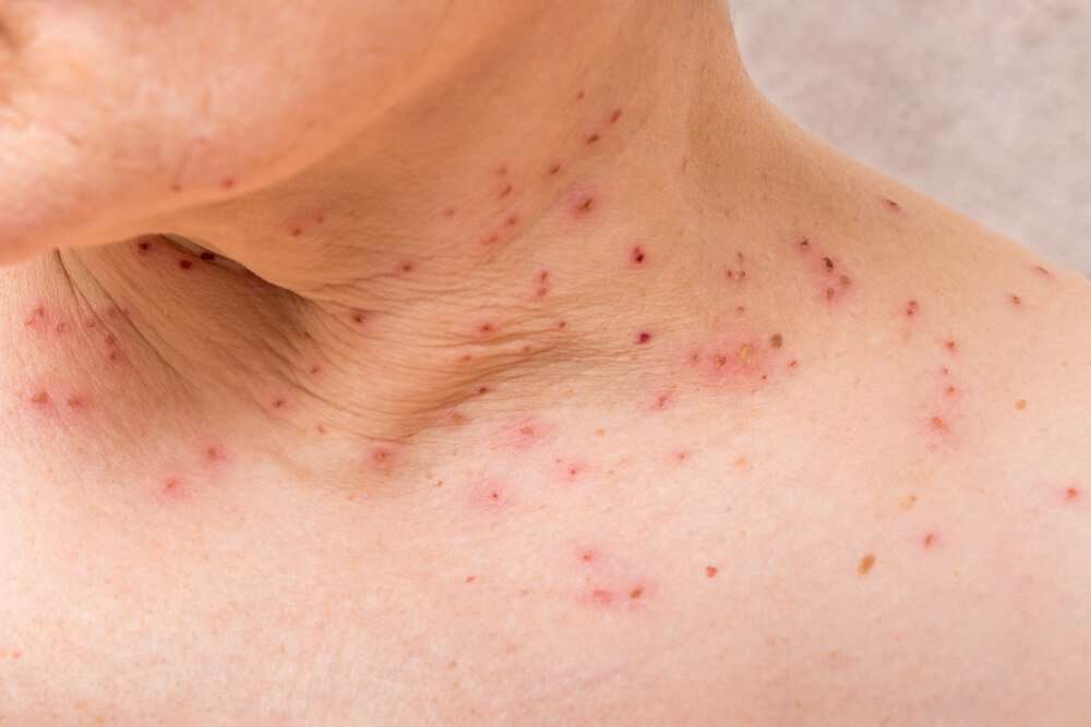 pinprick-red-dots-on-skin-not-itchy-vermontaco