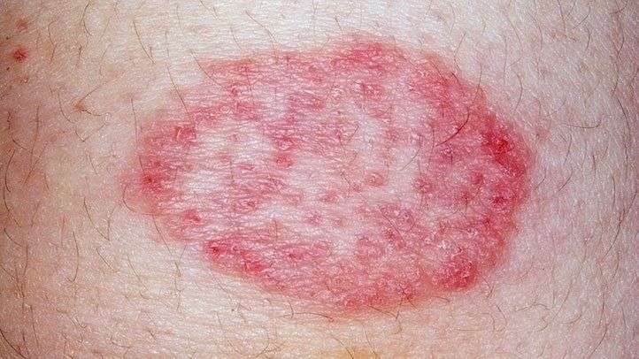 Pinprick red dots on skin not itchy - vermontaco